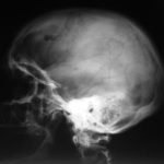 Изображение интрадуральной опухоли на снимке МРТ