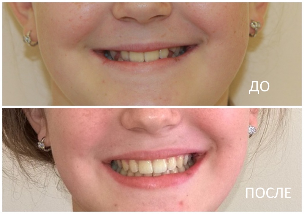 Девочка, которая начинала ортодонтическое лечение - подросток, с неуверенной стеснительной улыбкой