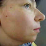 Подтяжка лица без операции нитями Аптос