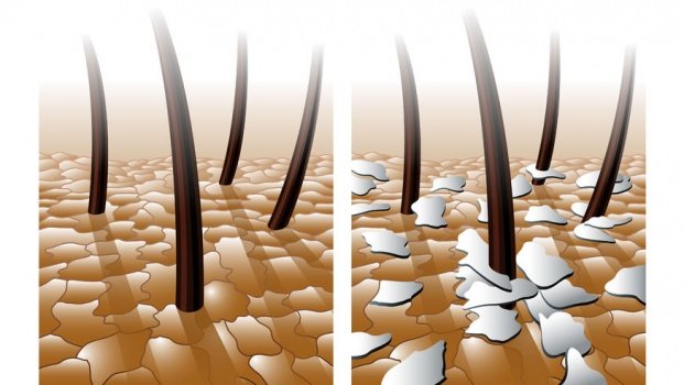 Образование перхоти