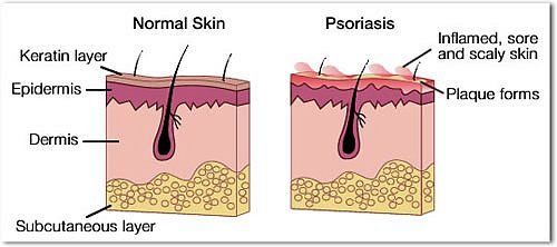 psoriaz-chto-eto-1312799379