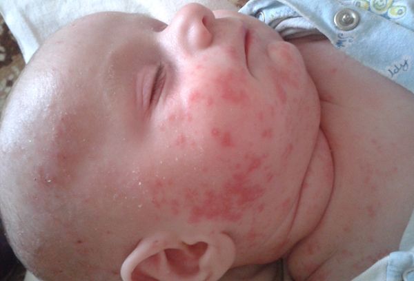 аллергическая сыпь у ребенка