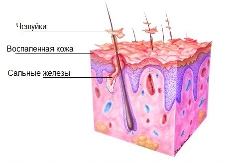 Чешуйки сухой перхоти