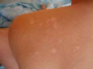 Солнечные ожоги от недостатка меланина в коже