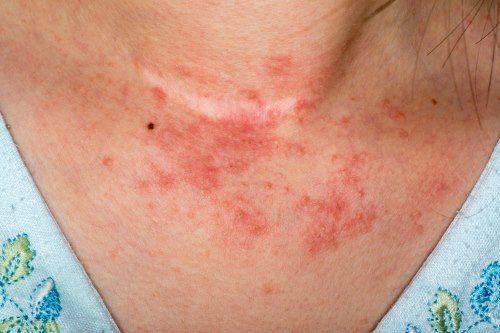 Contact Dermatitis