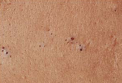 Комедоны (acne comedonica)