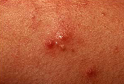 Папулопустулезные угри (acne papulopustulosa)