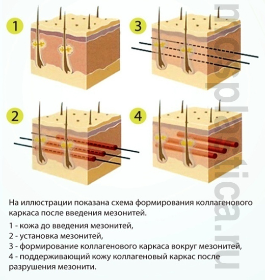 3D мезонити тредлифтинг