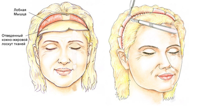 Схема разрезов при эндоскопической подтяжке верхней части лица