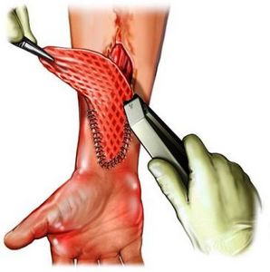 Кожная пластика после ожогов