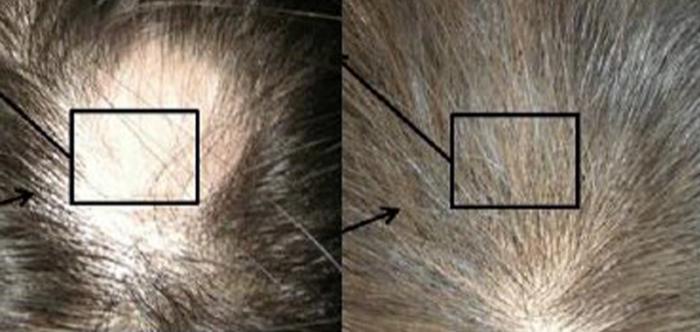 мезотерапия для волос мужчинам 