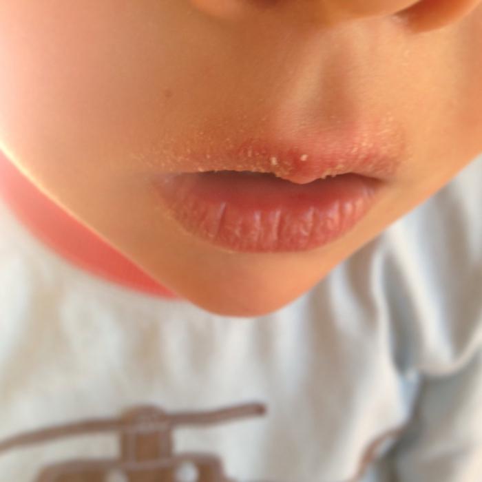 почему сохнут губы у ребенка