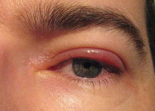 болезни век глаза лечение 