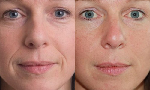 уколы гиалуроновой кислоты – фото до и после (лицо)