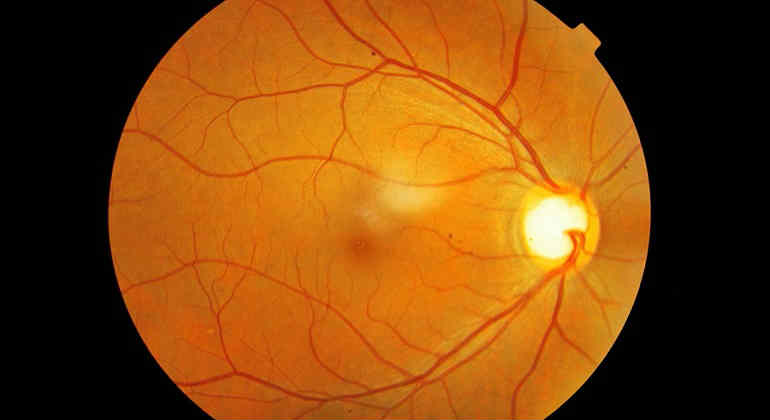Глаукома фото глазного дна 