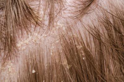 5 масок для кожи волосистой части головы помогут от шелушения и зуда