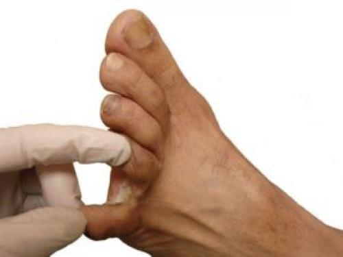 Сухая мозоль между пальцами ног. Возможные причины возникновения