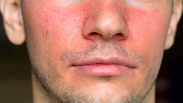 Способы лечения себореи на лице